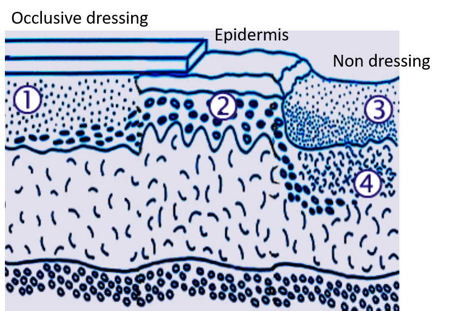 درمان زخم توسط پانسمان های مدرن