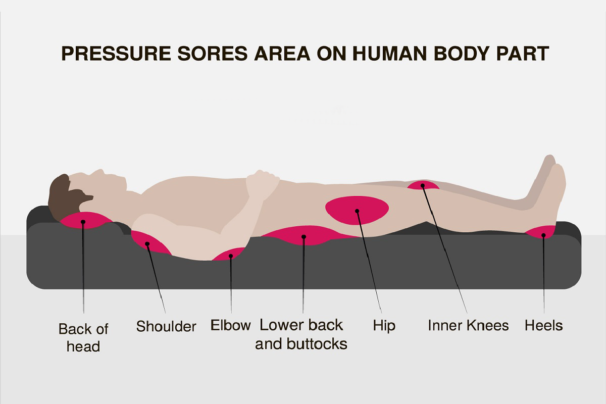 همه چیز درباره ی زخم های فشاری
