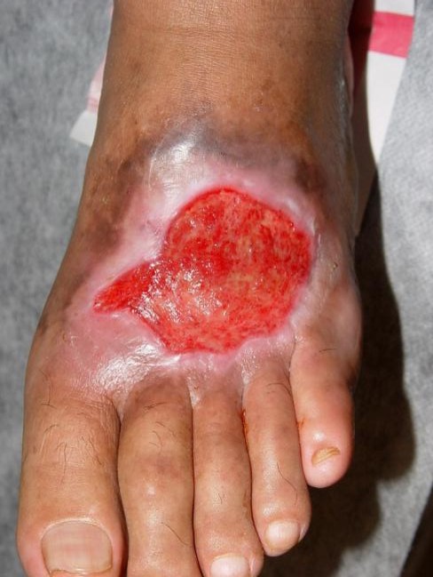 اپیتلیالیزاسیون