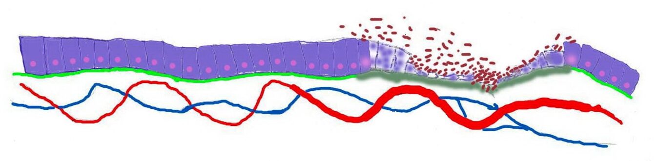 عفونت زخم و بهترین راه های درمان آن