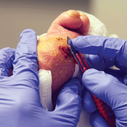 انواع روش های دبریدمان زخم و کاربرد های آن ها