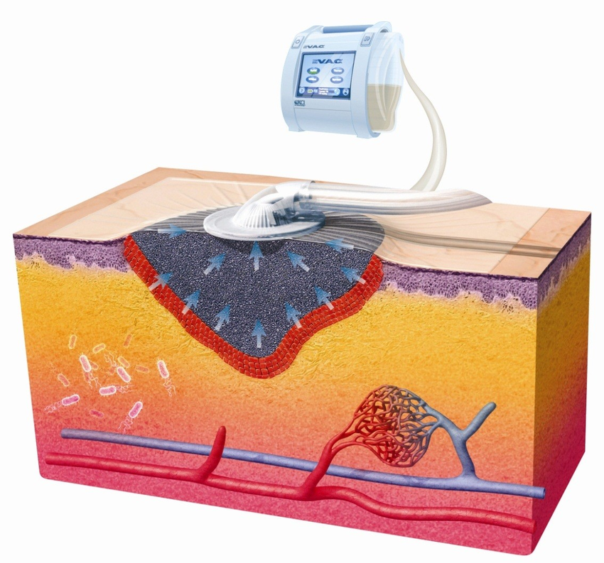 وکیوم تراپی و بکارگیری آن در درمان زخم